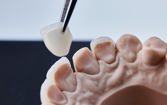 Tweezers placing a veneer over a model of a tooth