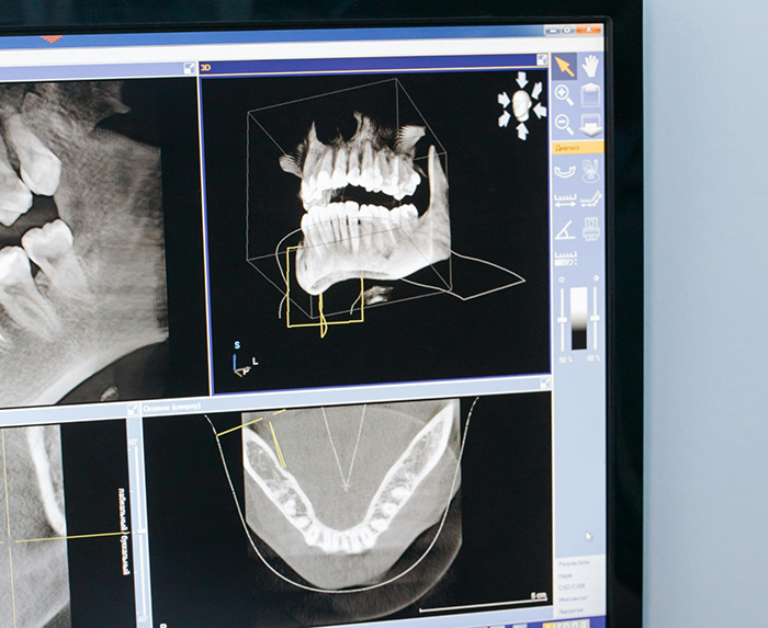 Screen showing digital models of a patients teeth and jaws