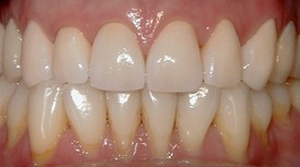Close up of a mouth with much whiter teeth