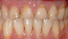 Close up of a mouth with yellowed teeth