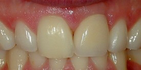 Mouth with a complete row of upper front teeth