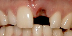 Mouth with a missing upper front tooth
