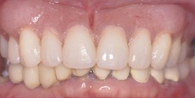 Mouth with two complete rows of teeth