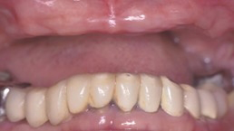Mouth that is missing all upper teeth