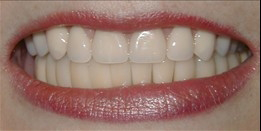 Mouth after whitening the teeth