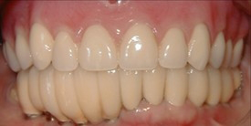 Mouth with slightly yellowed teeth