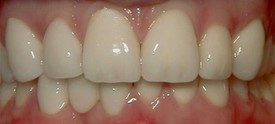Mouth with brighter and more evenly shaped teeth