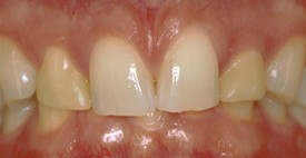 Mouht with slightly discolored and misshapen teeth