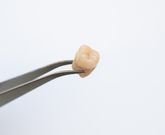 Tweezers holding an extracted tooth
