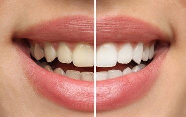 Up-close view of stained and brighter teeth 