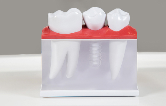 Dental Implant Treatment
