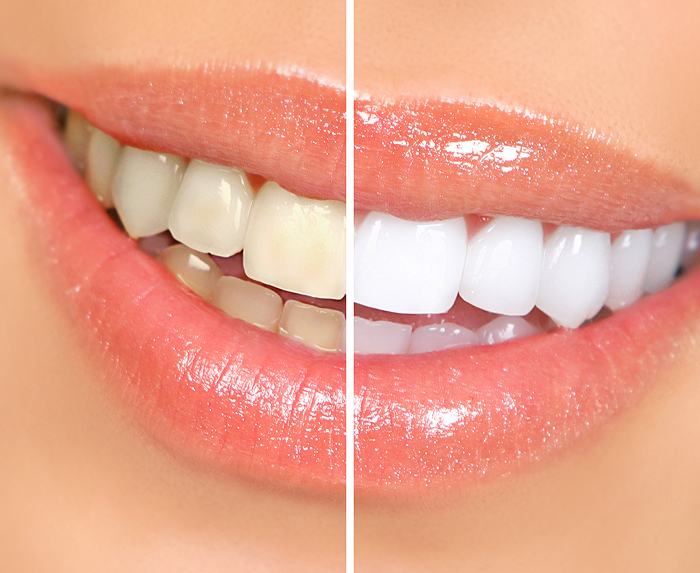 Teeth Whitening