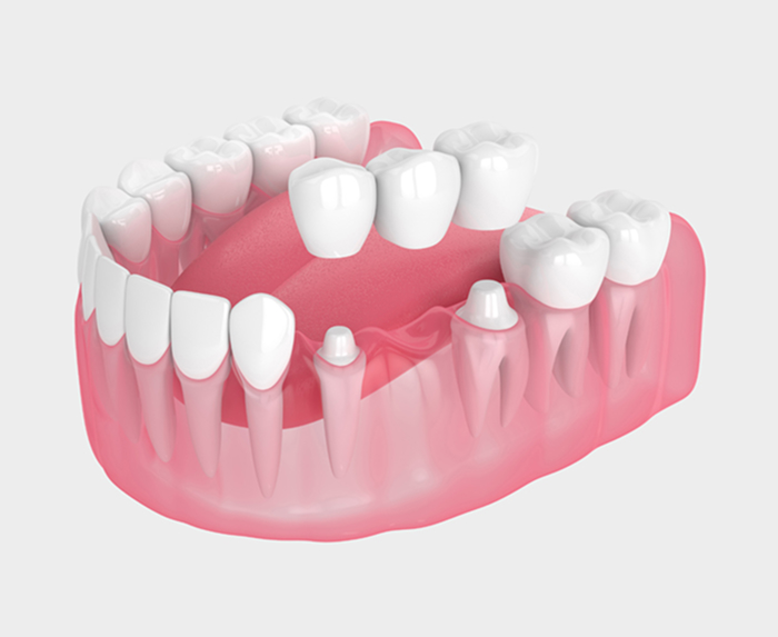Dental Bridges