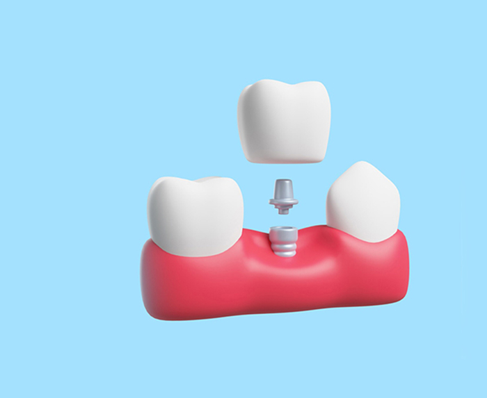 Dental Implants