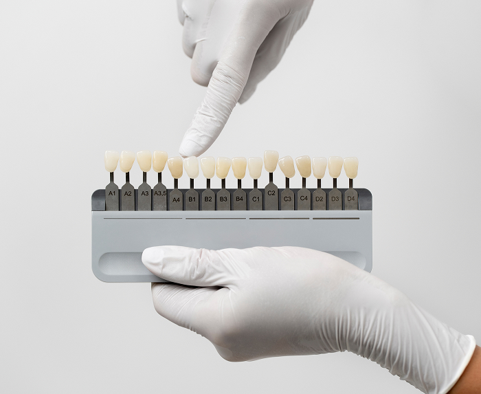 Porcelain and Composite Veneers