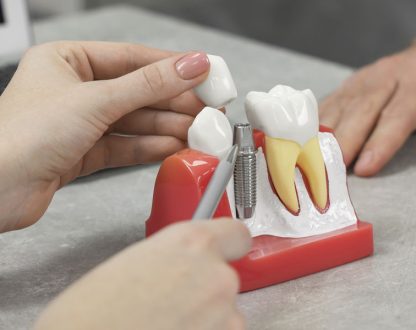 Understanding the Process of Dental Implants: A Solution for Missing Teeth